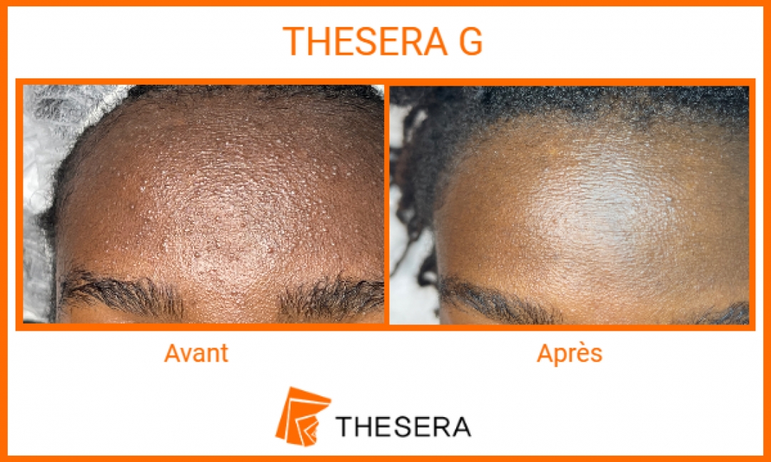 peeling G thesera avant-après